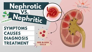 Nephrotic vs Nephritic syndrome  Symptoms diagnosis causes treatment  Visual explanation [upl. by Drusus]