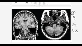 Facial Nerve Anatomy Tutorial 2  Intracranial Course  Mosaicedorg [upl. by Dodge]