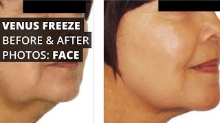 Venus Freeze™ Before amp After Photos Face [upl. by Pyle]