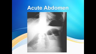 Acute abdomen [upl. by Proctor]