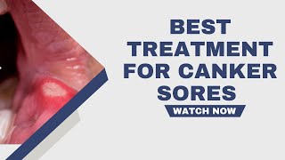 Best Treatment for Canker Sores To Try at Home [upl. by Eelarual]