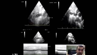 IVC Diameter and Collapsibility [upl. by Anwad901]