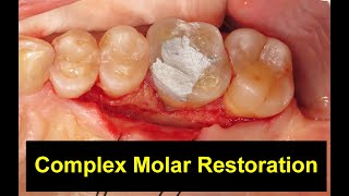 Misdiagnosed Molar Case [upl. by Schreiber]