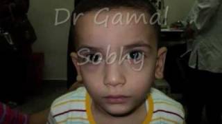 الحول الوحشي المتقطع  Intermittent Exotropia [upl. by Barrett]