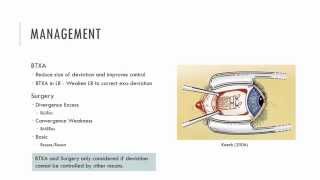 Exophoria Management [upl. by Oak]