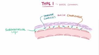 Membranoproliferative glomerulonephritis MPGN causes symptoms amp pathology [upl. by Gromme]