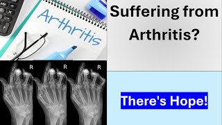 Arthritis Cure Found New Biomaterial Regenerates Cartilage [upl. by Ahsenrac]