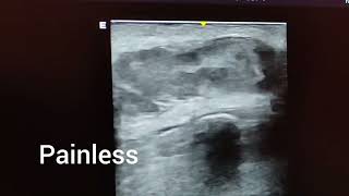 Sebaceous cyst ultrasound and color Doppler video [upl. by Gomar377]