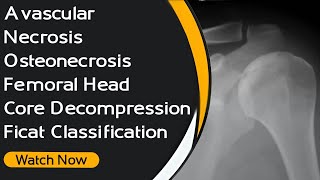 Avascular Necrosis  Osteonecrosis  Femoral Head  Core Decompression  Ficat Classification [upl. by Kesley]