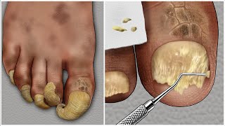 ASMR 두꺼운 무좀 발톱 케어 애니메이션  thick athletes foot toenail treatment animation [upl. by Hafirahs619]