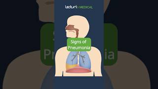 Recognizing the Signs of Pneumonia 🩺 MedicalEducation USMLE [upl. by Sordnaxela]