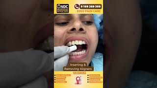 Aligner Tips  Inserting And Removing Aligners safely  Best Dental Hospital In Hyderabad  NDC [upl. by Idou]