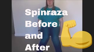 Spinraza Before and After [upl. by Baugh807]