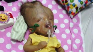 Toddler with Birth Defects Incompatible with Life Defies Odds in Venezuela [upl. by Llydnek113]