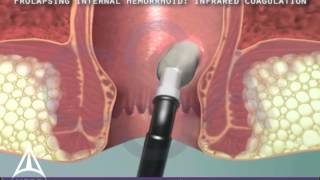 Infrared Coagulation Therapy for Hemorrhoids  3D Medical Animation [upl. by Wichern145]