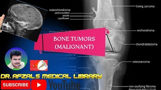 Bone tumors malignant  bone cancers [upl. by Waterman]