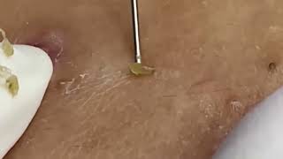 blackheads new this week  popping pimple asmr  blackheads and whiteheads removal [upl. by Ulric]