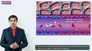 1Edema introduction  Hemodynamic pathology Fmge Neet PG and usmle [upl. by Amber]