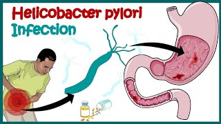 Helicobacter Pylori Infection Gastric Ulcer Causes Signs and Symptoms [upl. by Kavanagh756]