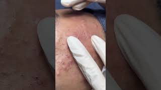 Satisfying Relaxing with Vien Tham My DrAZI acne pimples blackheads [upl. by Valdis]