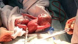 Born At 24WeekOld Abortion Limit Saying Shes Not A FoetusShes A FullyFormed Human Being [upl. by Fesoj229]