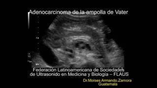 Adenocarcinoma de la ampolla de Vater [upl. by Neiviv]