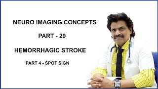 NEURO IMAGING CONCEPTS PART  29HEMORRHAGIC STROKE PART 4 SPOT SIGN [upl. by Cleave309]