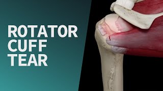 Rotator Cuff Tear [upl. by Shira]