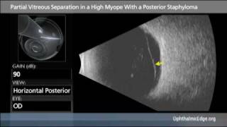 Partial Vitreous Separation In A High Myope With A Posterior [upl. by Sherurd]