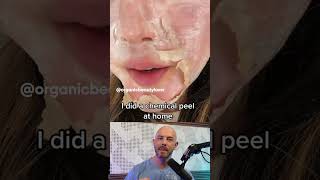 Reacting to this chemical peel thats done at home 🫣 credit organicbeautylover on TT [upl. by Iur]