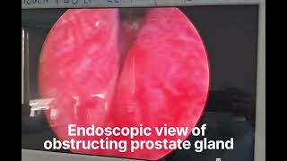 Transurethral Resection of Prostate TURP for Obstructing prostate gland [upl. by Pahl]