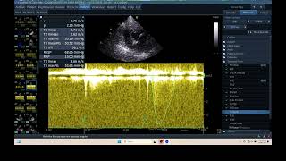 IQ 306 HEMODYNAMIC ECHOPAC ANALYSIS ECHOCARDIOGRAPHY HEPATOMA PTE [upl. by Logan]