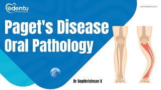 Pagets Disease  Oral Pathology  NEET MDS  edentu neetmds neetmds2025 dentistry [upl. by Sherburne]