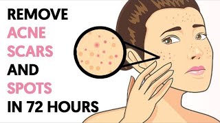 How to Get Rid of Acne Scars and Spots in 72 Hours [upl. by Ekenna]