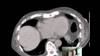 CT Abdomen and Pelvis ANATOMY Discussion by Radiologist [upl. by Agate]