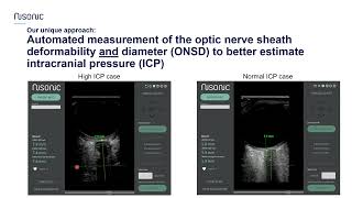 Nisonic  the physiology and principles for noninvasive measurement of ICP [upl. by Kent]