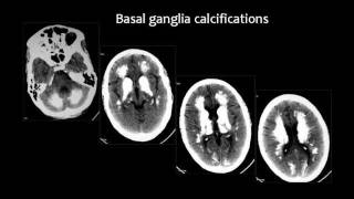 Radiology  Imaging of Intracranial Calcifications  Brain [upl. by Ahsenar426]