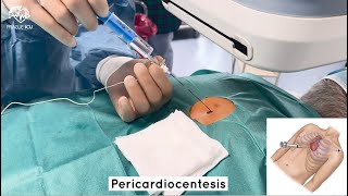 Pericardiocentesis [upl. by Nandor876]