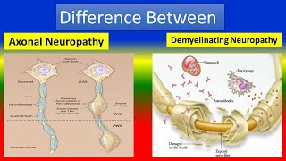 Different between Axonal Neuropathy and Demyelinating Neuropathy [upl. by Aisatsan]