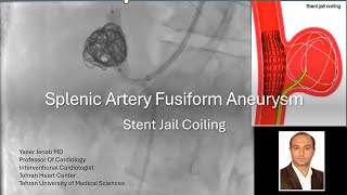 Splenic artery aneurysm stent jail coiling [upl. by Aicemak]