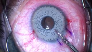 Want to change your eye color Think twice Iris Implant Removal JT Kavanagh MD San Antonio TX [upl. by Osana]