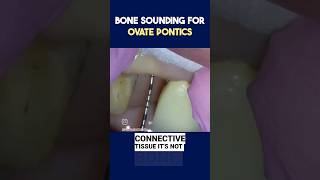 Clinical Video How to Bone Sound for Bridges dentistry [upl. by Sheply]