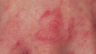 DO YOU HAVE SCABIES CLOSE LOOK AT THE SCABIES RASH [upl. by Rehtul]