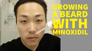 Can Asians Grow Beards With Minoxidil [upl. by Ormsby669]