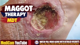 Maggot Therapy  Maggot Debridement Therapy MDT [upl. by Htebezile]