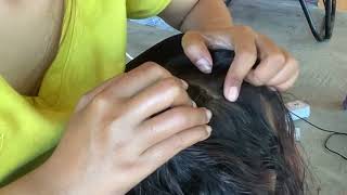 Satisfying ASMR Nits Removal on Scalp 2024 [upl. by Herra420]