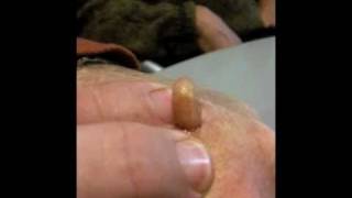 Man Squeezes Botfly from Hand [upl. by Scarrow]