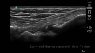 Ultrasound of anteromedial ankle impingement [upl. by Misti]