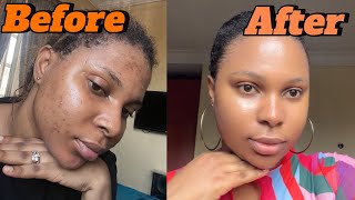 How I cleared my acne using 2 products My acne journey [upl. by Nna859]