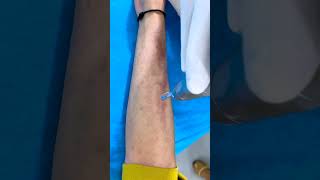 Laser treatment for lichen Planus Pigmentosus Treatment  Skinaa Clinic viral viralshort [upl. by Rudiger]